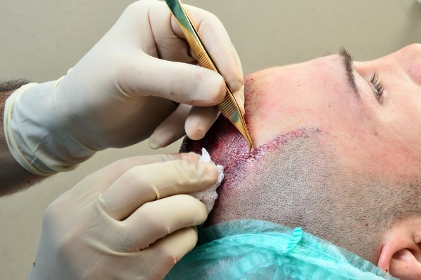 Skin xperts Super speciality Skin,Hair and Laser Clinics - Service - Hair Transplant