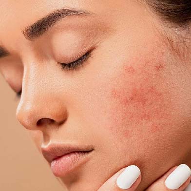 Skin xperts Super speciality Skin,Hair and Laser Clinics - Latest update - Acne pimples and dark spots Treatment in Rajajinagar