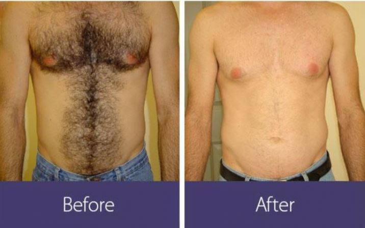 Skin xperts Super speciality Skin,Hair and Laser Clinics - Latest update - Laser Hair Removal In Jayanagar