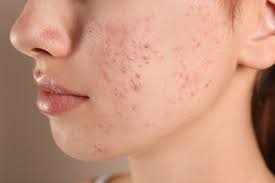 Skin xperts Super speciality Skin,Hair and Laser Clinics - Latest update - Skin Allergy Treatment in Rajajinagar