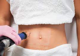 Skin xperts Super speciality Skin,Hair and Laser Clinics - Latest update - Stretch mark treatment in Bangalore