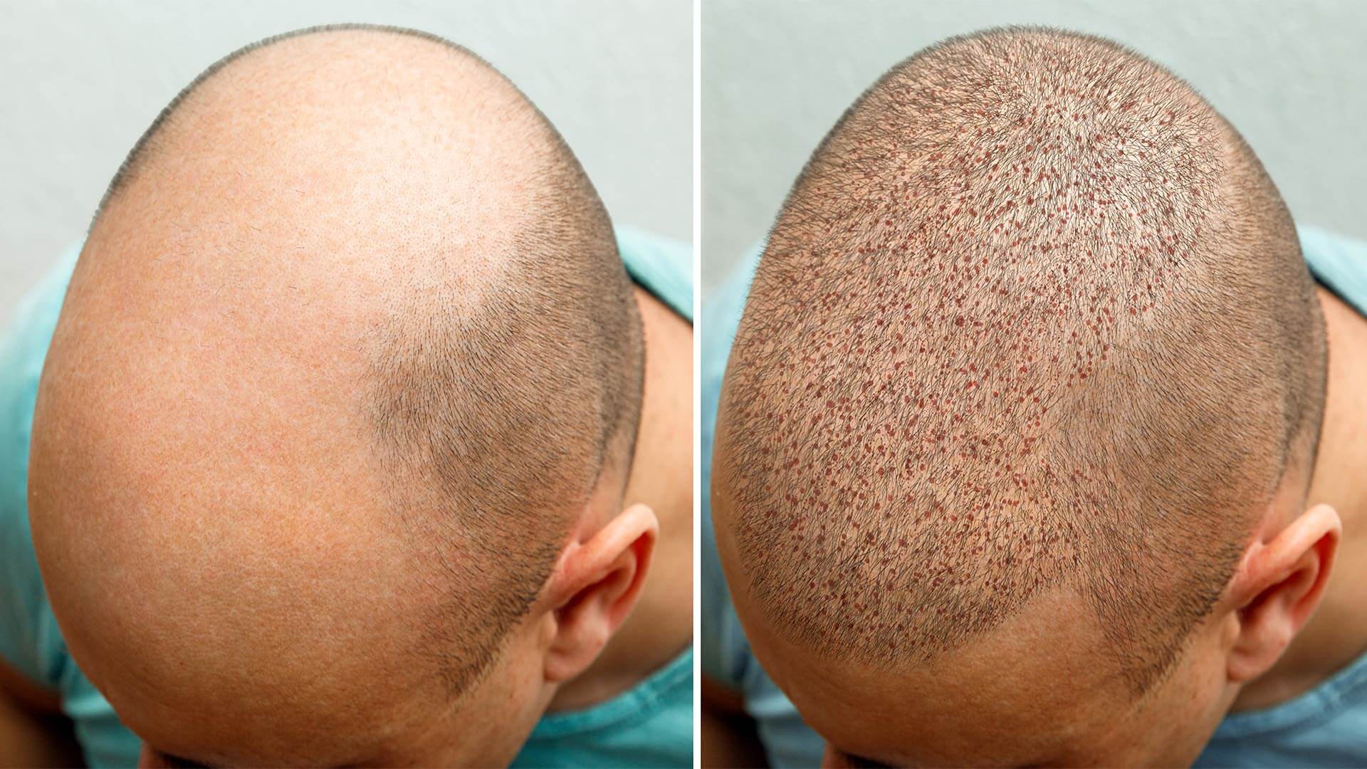 Skin xperts Super speciality Skin,Hair and Laser Clinics - Latest update - Hair Transplant Clinic Near Jayanagar