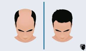 Skin xperts Super speciality Skin,Hair and Laser Clinics - Latest update - Hair Transplant Clinic Near Jayanagar