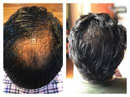 Skin xperts Super speciality Skin,Hair and Laser Clinics - Latest update - Hair Transplant in J.P Nagar