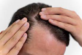 Skin xperts Super speciality Skin,Hair and Laser Clinics - Latest update - Best Hair Treatment for Hair Fall