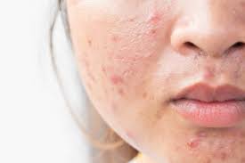 Skin xperts Super speciality Skin,Hair and Laser Clinics - Latest update - Best Acne Scar Treatment Near Kengeri