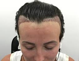 Skin xperts Super speciality Skin,Hair and Laser Clinics - Latest update - Hair Implantation Experts near Kengeri