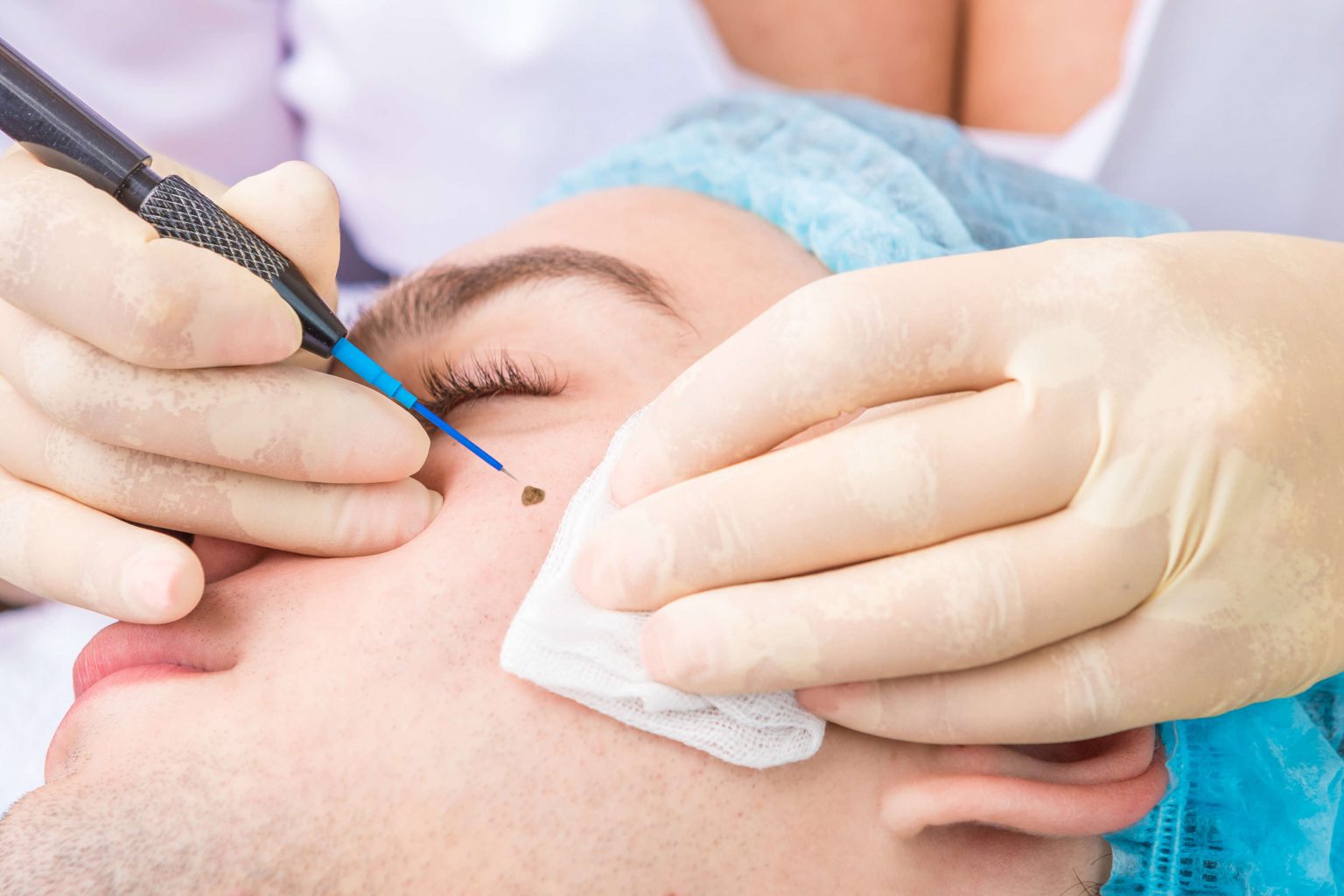 Skin xperts Super speciality Skin,Hair and Laser Clinics - Latest update - Mole Removal Treatment near Kengeri