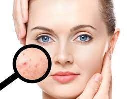 Skin xperts Super speciality Skin,Hair and Laser Clinics - Latest update - Pimple Treatment In Rajajinagar