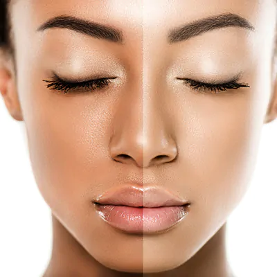 Skin xperts Super speciality Skin,Hair and Laser Clinics - Latest update - Skin Whitening Treatment in Bangalore