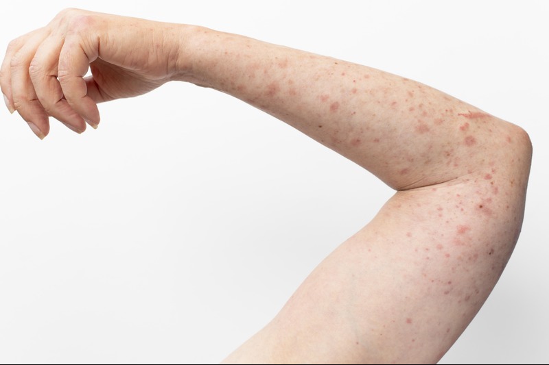 Skin xperts Super speciality Skin,Hair and Laser Clinics - Latest update - Skin Allergy Treatment in Bangalore