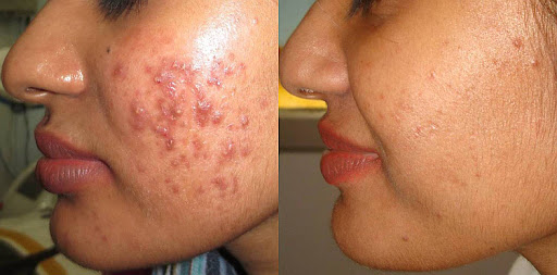 Skin xperts Super speciality Skin,Hair and Laser Clinics - Latest update - Acne Treatment Near Rajajinagar